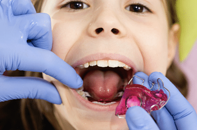 Phase 1 or early orthodontic treatment (part 2 of 4) 5 Early orthodontic treatment