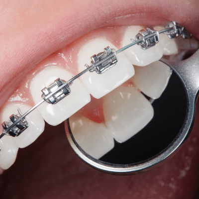My journey to orthodontics 6 Dental mirror looking at braces, representing orthodontic care