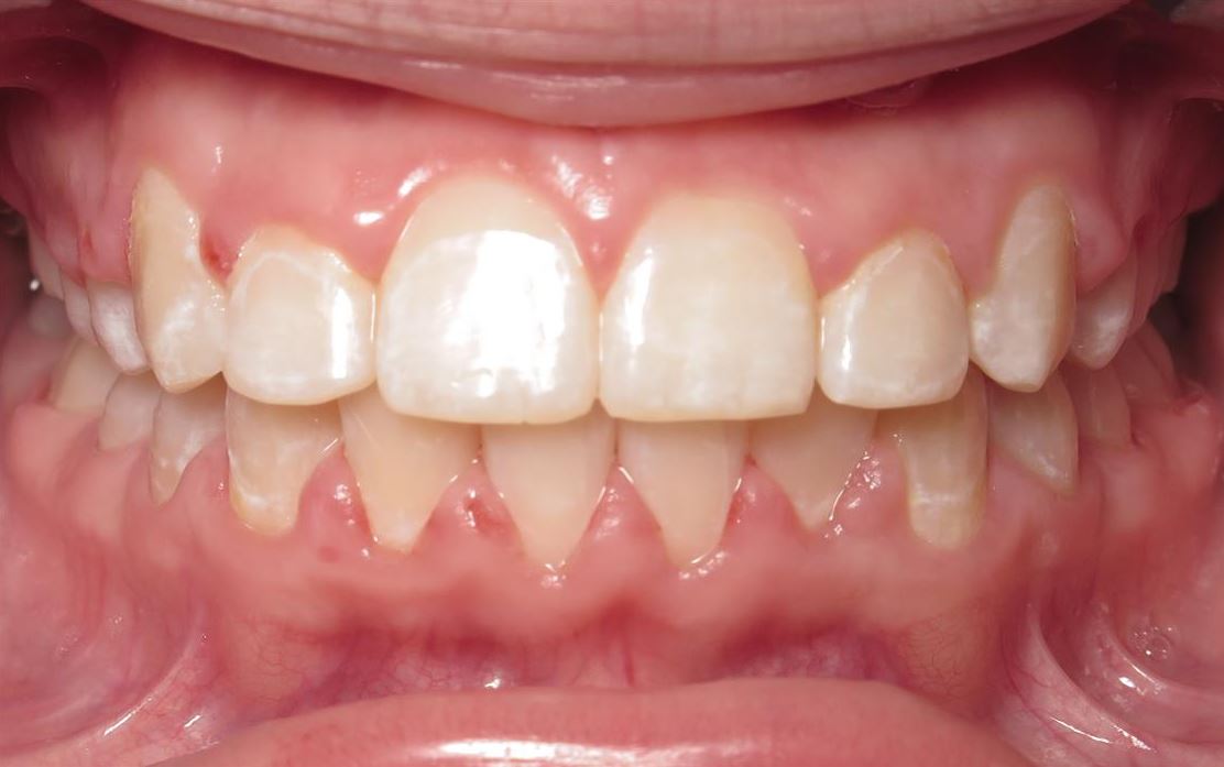 More smile transformations 187 Post treatment results at joosse family orthodontics