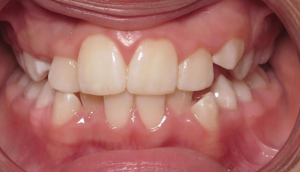 More smile transformations 186 Before orthodontic treatment at joosse family orthodontics williamsburg va