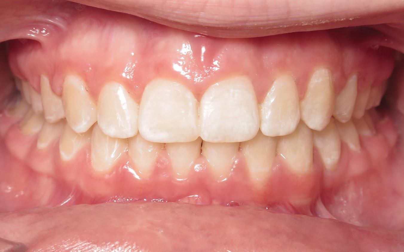 More smile transformations 272 After braces treatment joosse family orthodontics williamsburg va