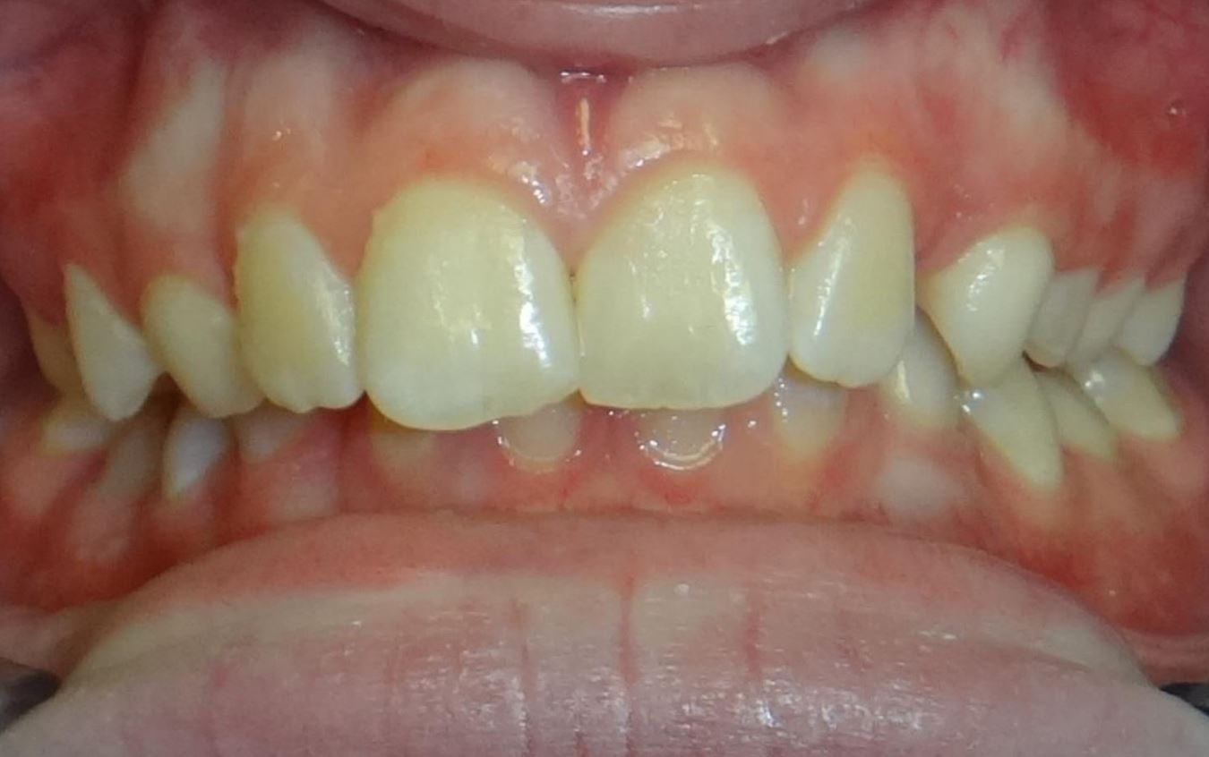 More smile transformations 271 Before treatment at joosse family orthodontics
