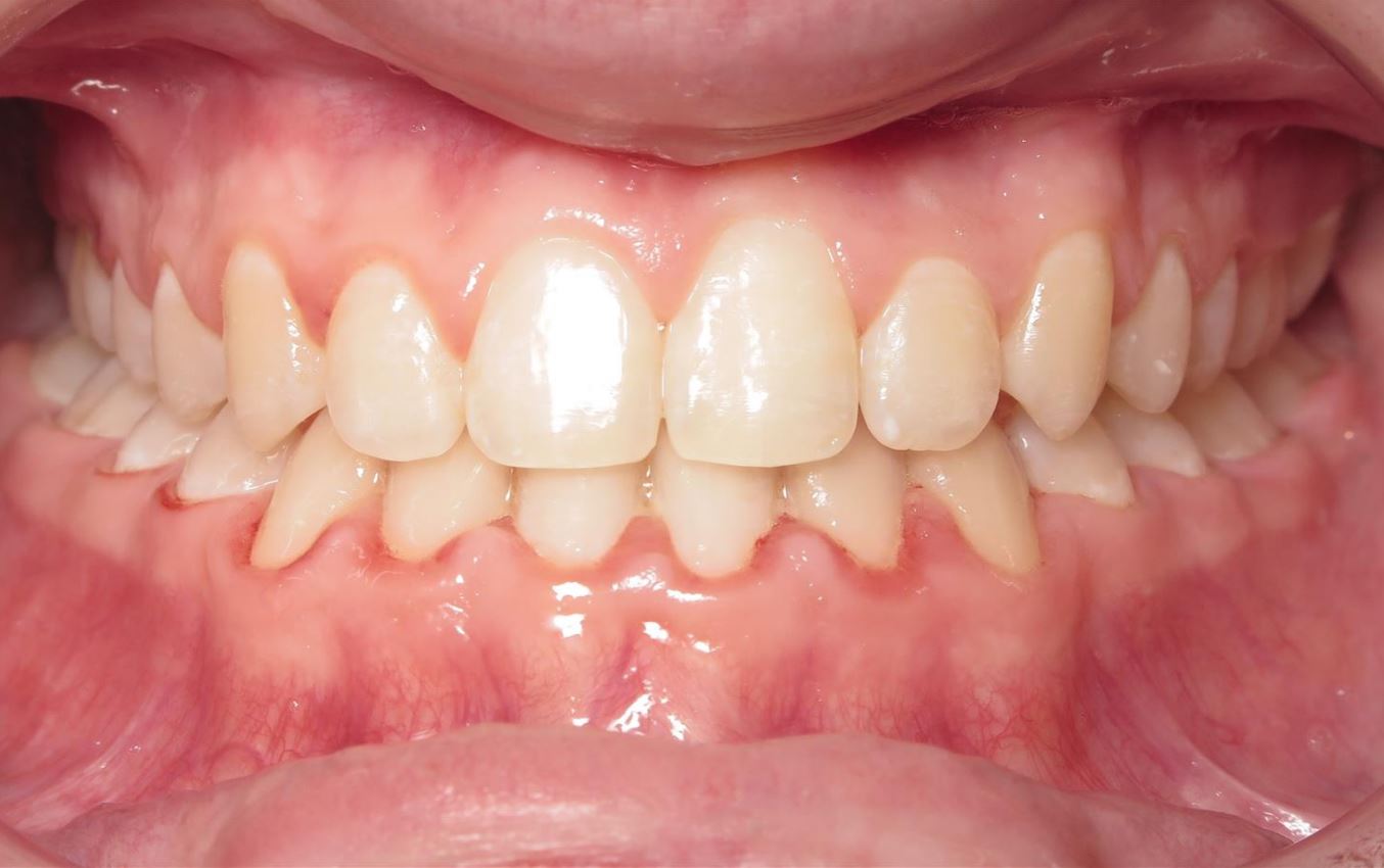 More smile transformations 171 Virtual smile assessment joosse family orthodontics