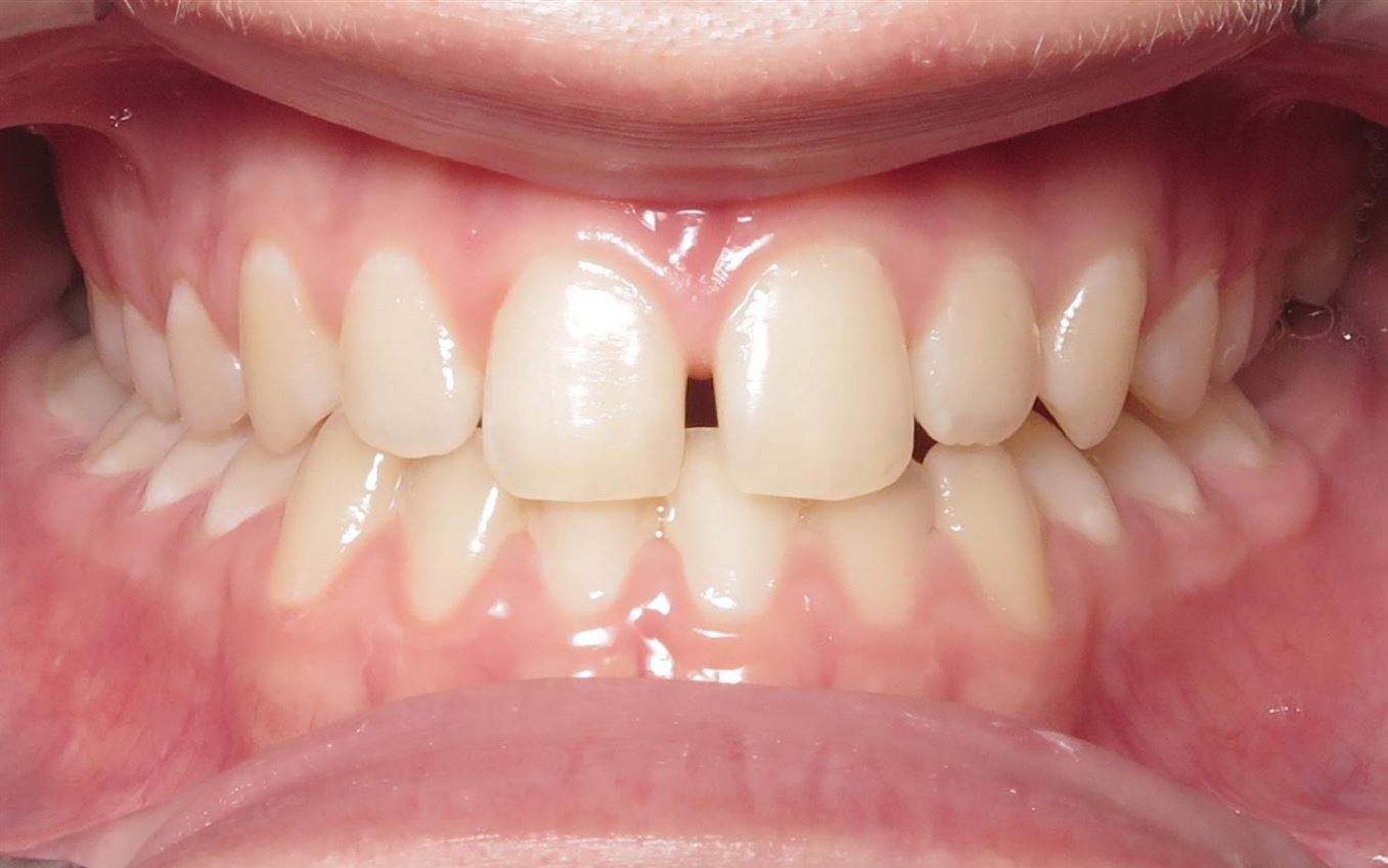 More smile transformations 170 Front picture virtual smile assessment joosse family orthodontics