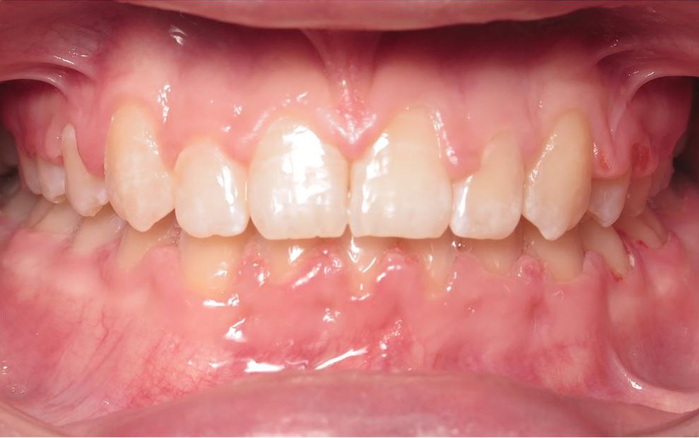 More smile transformations 286 Smile gallery joosee orthodontics kenley after treatment