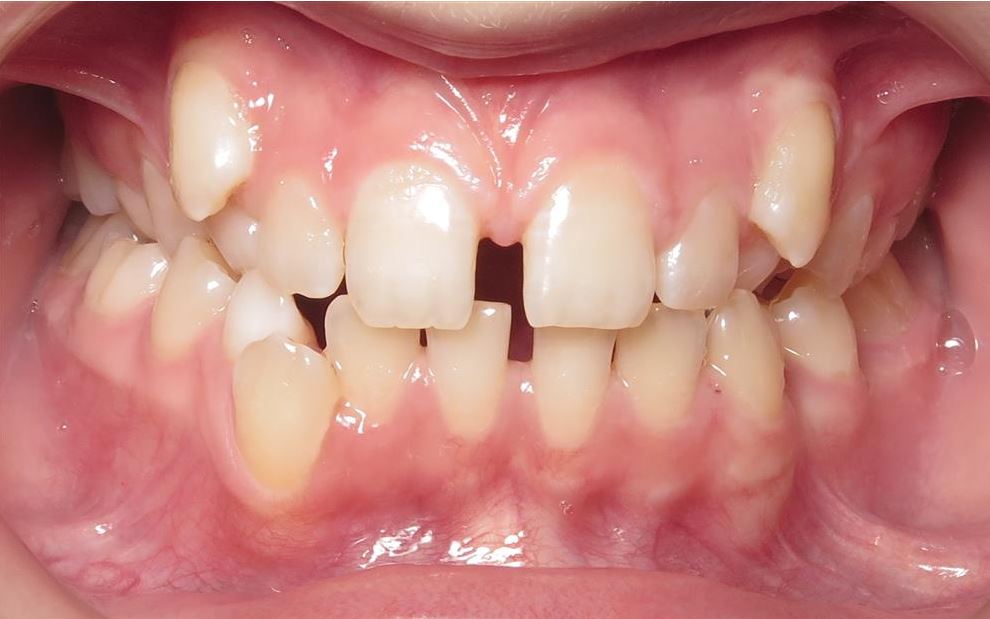 More smile transformations 285 Smile gallery joosse orthodontics kenley before treatment