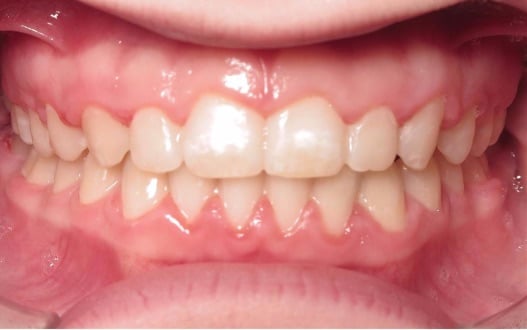 More smile transformations 259 Smile gallery haileigh finish