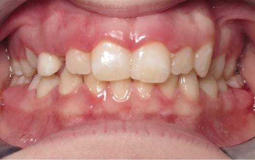 More smile transformations 258 Smile gallery haileigh start