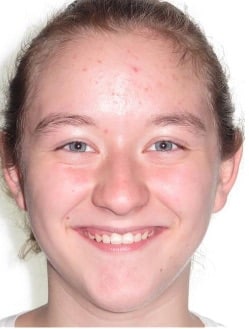 More smile transformations 257 Full face jfo patient haileigh finish