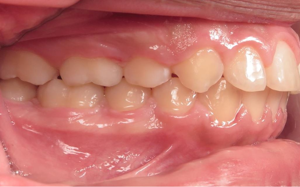 More smile transformations 231 Smile gallery buccal finish