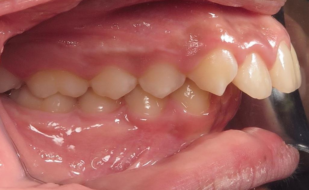 More smile transformations 230 Smile gallery buccal start