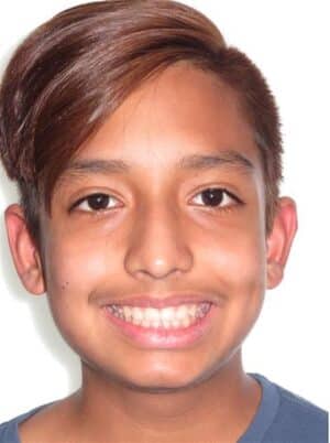 Samuelsmile Jfo patient smile
