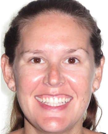 More smile transformations 247 Full face ashley smile finish