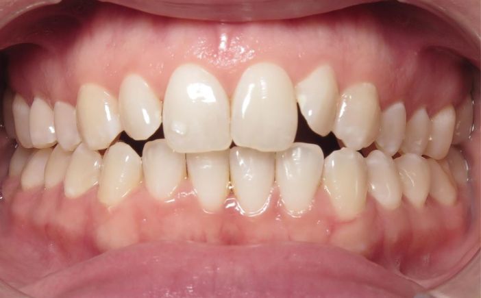 More smile transformations 244 Smile gallery ashley smile before