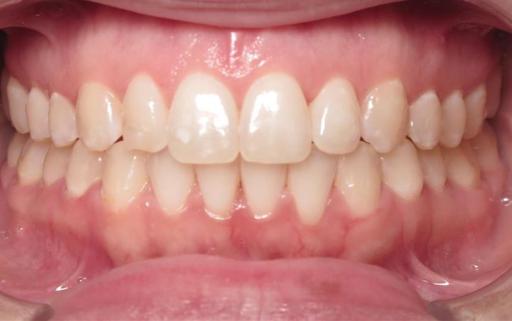 More smile transformations 245 Smile gallery ashley finish
