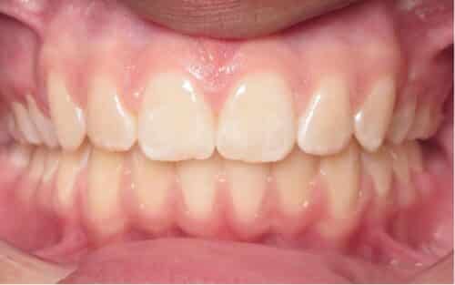 More smile transformations 229 Smile gallery alex center final