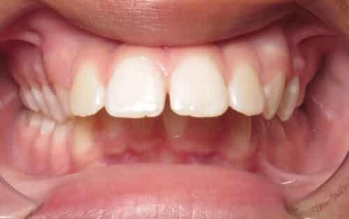 More smile transformations 228 Smile gallery alex center start