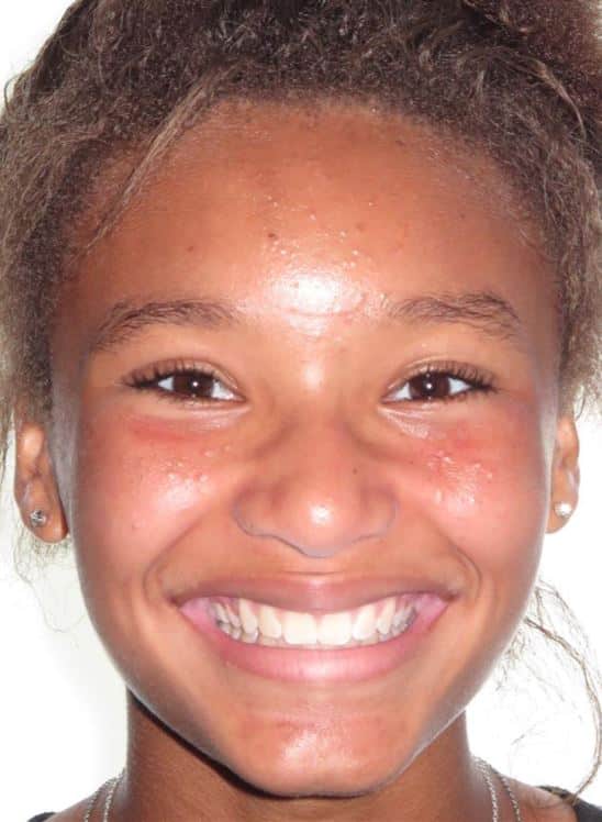 More smile transformations 227 Alex smile final