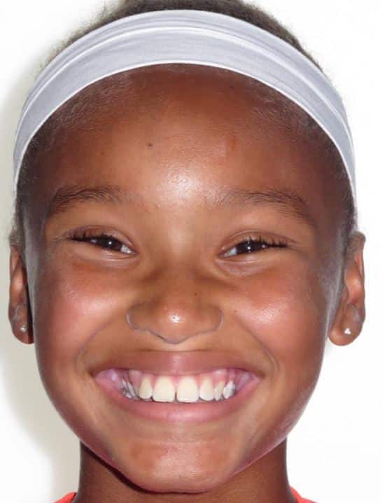 More smile transformations 226 Alex smile start