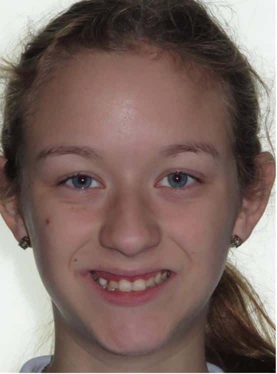 More smile transformations 256 Haileigh smile start