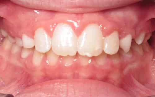 More smile transformations 151 Smile gallery jillian center final