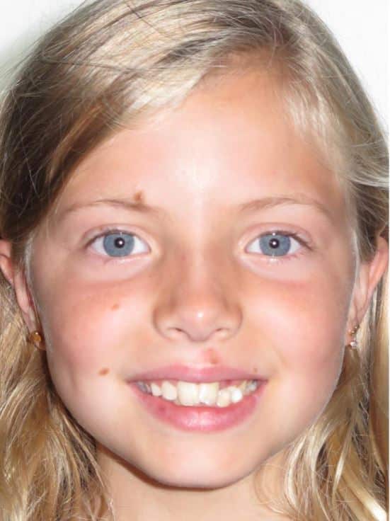 More smile transformations 148 Jillian smile start