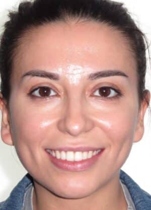 More smile transformations 157 Melis smile final