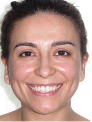 More smile transformations 156 Melis smile start