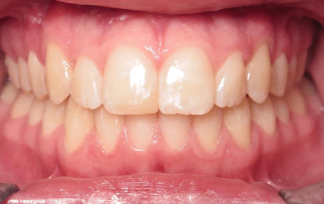 More smile transformations 215 Noah patient smile finish final treatment orthodontics
