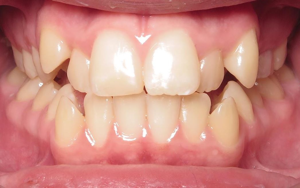 More smile transformations 214 Noah patient teeth start orthodontic treatment