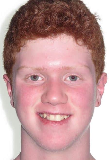 More smile transformations 216 Noah patient smile treatment start before
