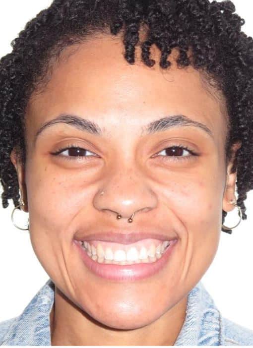 More smile transformations 211 Octavia smile treatment final