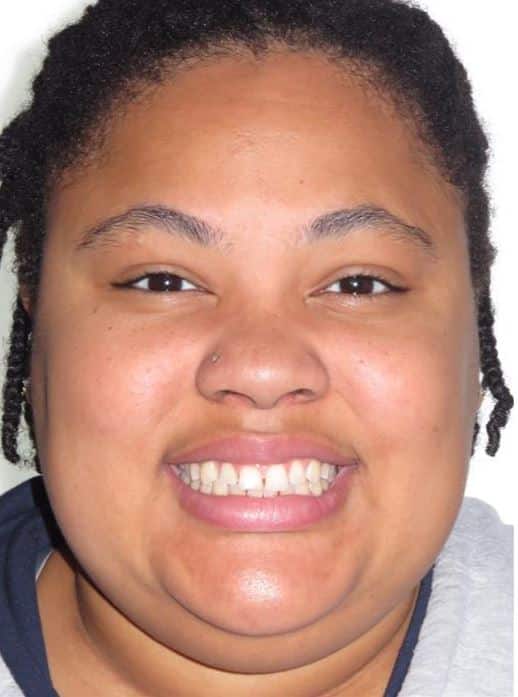 More smile transformations 210 Octavia smile treatment start