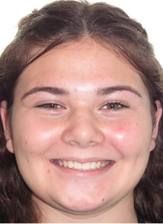 More smile transformations 243 Sam smile final