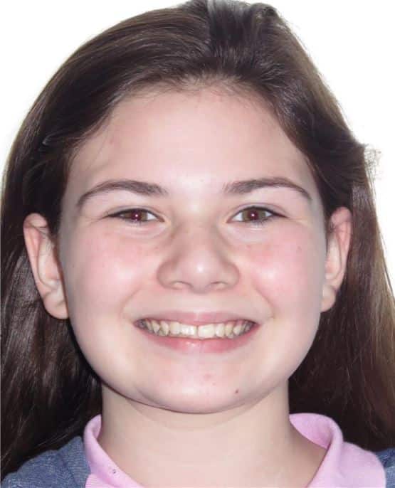 More smile transformations 242 Sam smile start