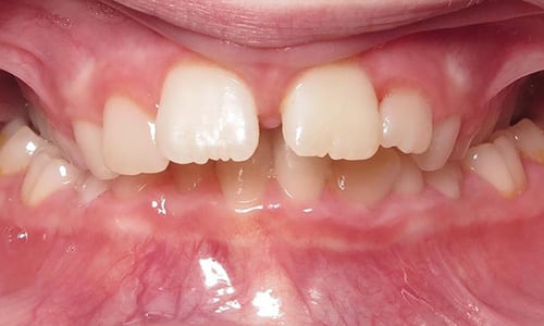 Phase 1 8 Smile gallery crossbite