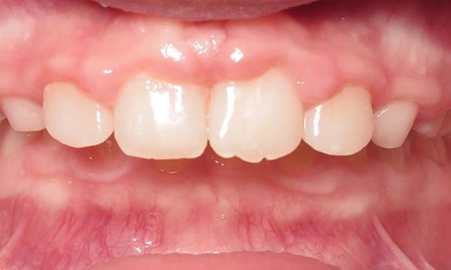 Phase 1 15 Smile gallery flared teeth after treatment