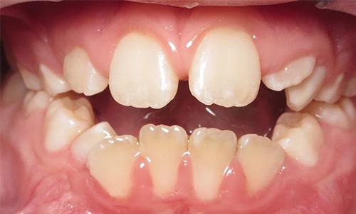 Phase 1 12 Smile gallery open bite