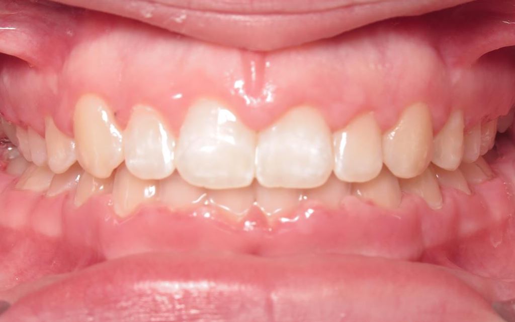 More smile transformations 199 Smile gallery taylors center final