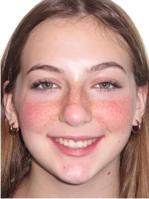 More smile transformations 201 Smile gallery smile after treatment