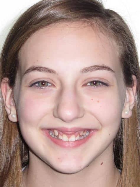More smile transformations 200 Orthodontics before smile treatment