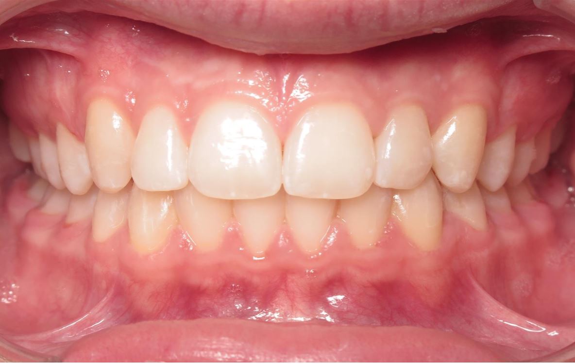 More smile transformations 197 Smile gallery emmy center final