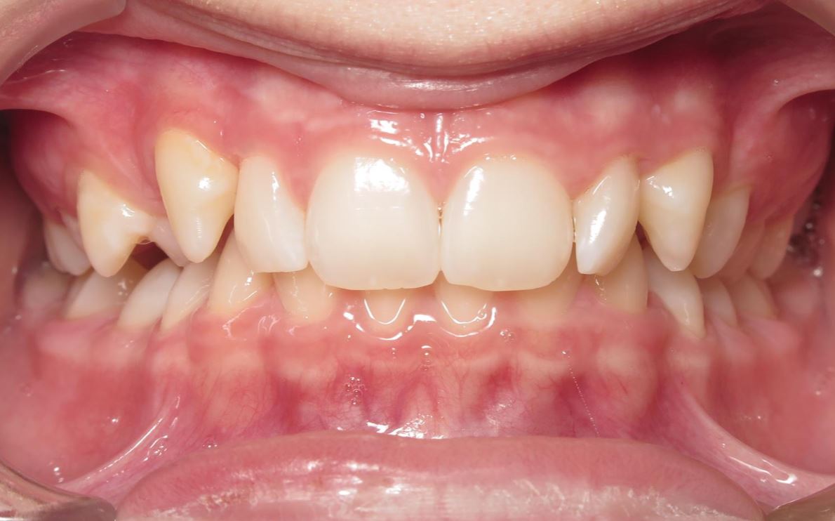 More smile transformations 196 Smile gallery emmy center start