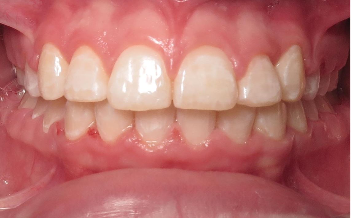 More smile transformations 179 Smile gallery abigail center final