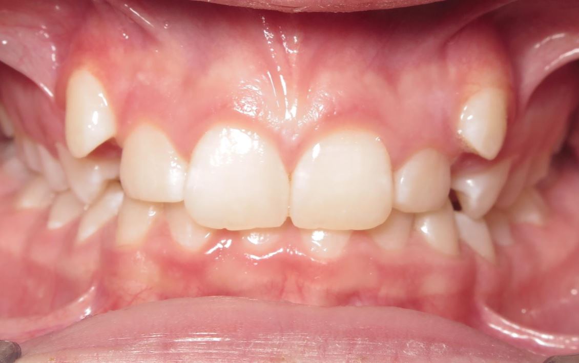 More smile transformations 178 Smile gallery abigail center start