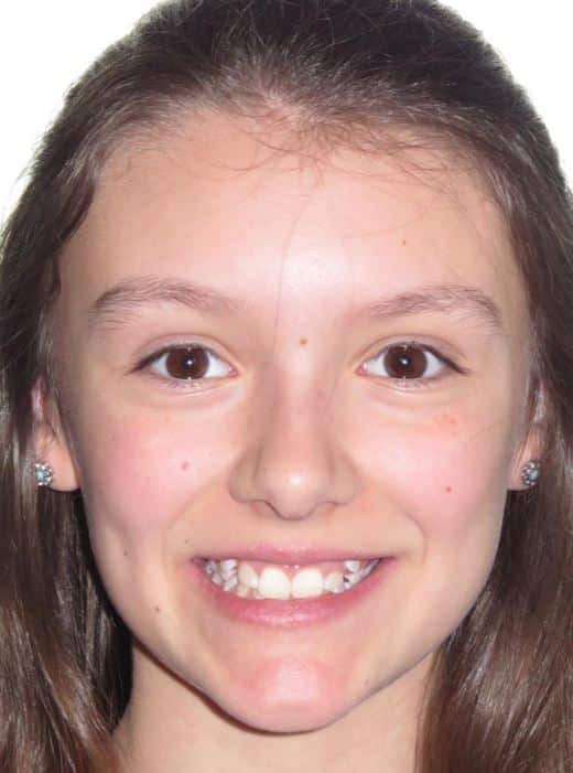 More smile transformations 180 Jfo patient before orthodontic treatment abigail smile start