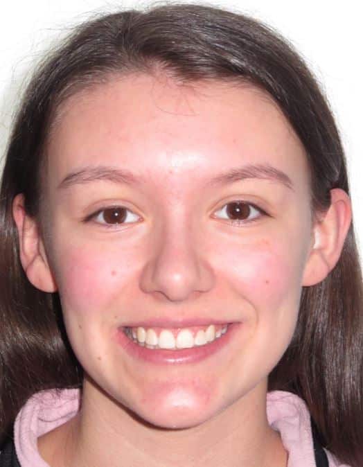 More smile transformations 181 Best smile results after orthodontics abigail smile final