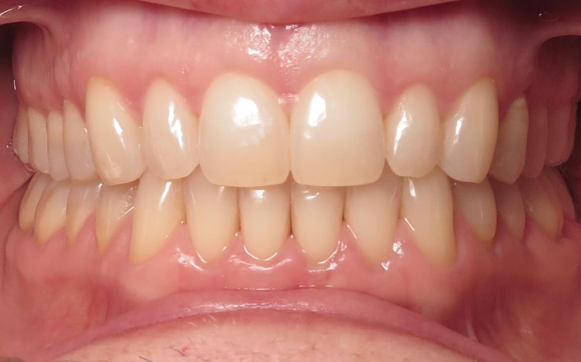 More smile transformations 183 Smile gallery ginger center final