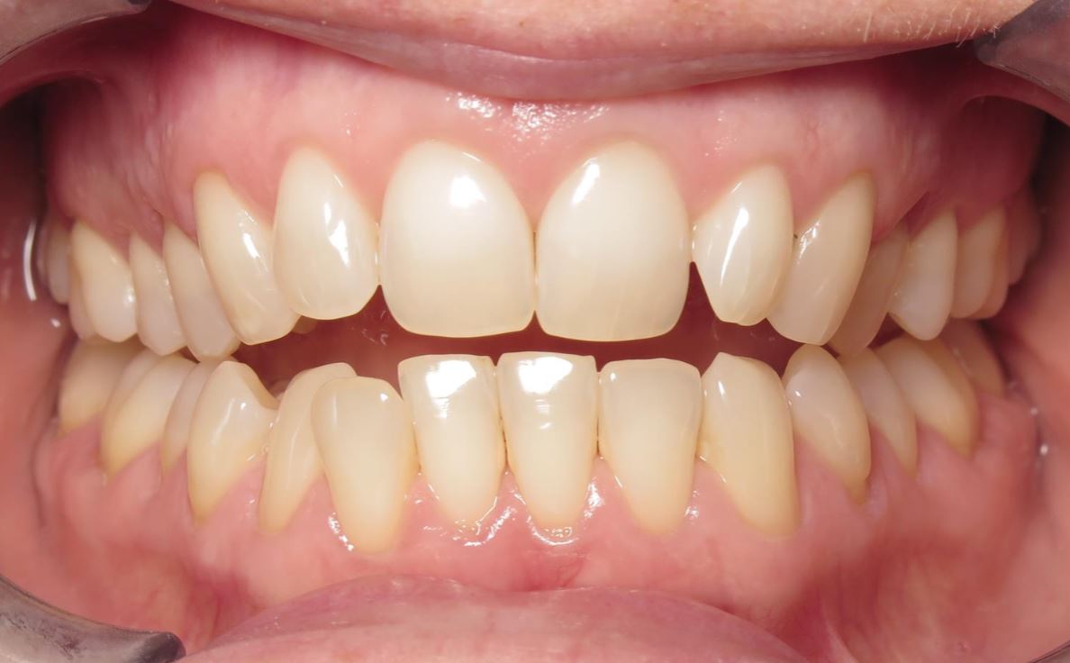 More smile transformations 182 Smile gallery ginger center start