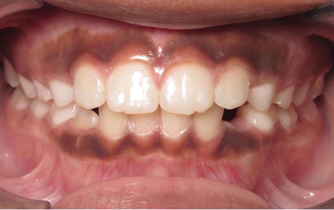 More smile transformations 169 J shepherd center final